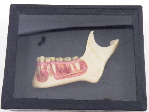 Anatomy: A cased 19th Century wax model of a human lower jawbone and tooth in ebonised and glazed