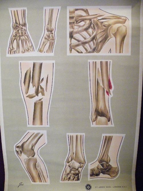 Vintage early 20th Century St Johns Ambulance wall chart displaying various fractures and breaks