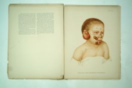 Atlas of the Diseases of the skin by Radcliffe Crocker, Volume first,