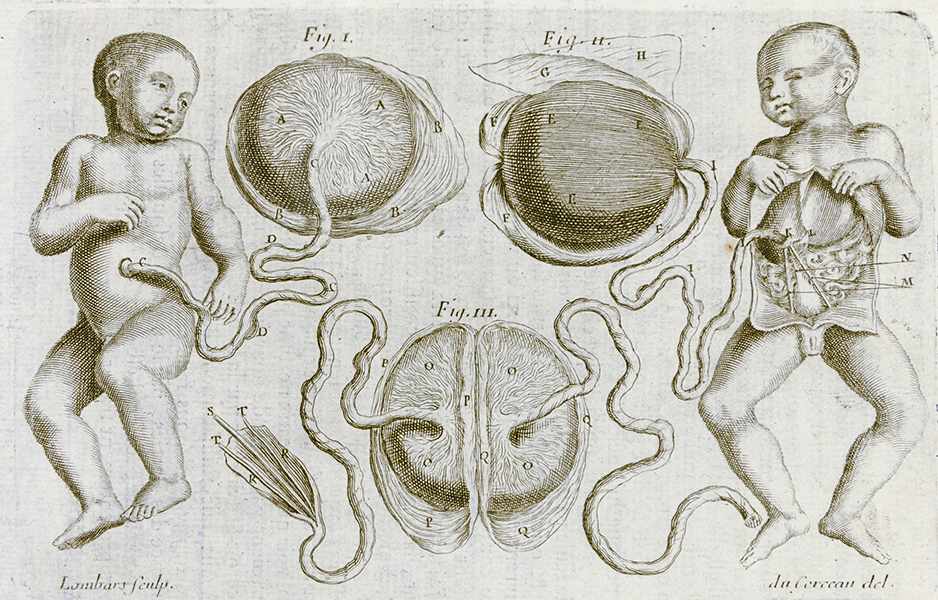 Medizin - Gynäkologie - - Mauriceau, Francois. Traité des maladies des femmes grosses, et de