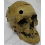 Human treapanned skull