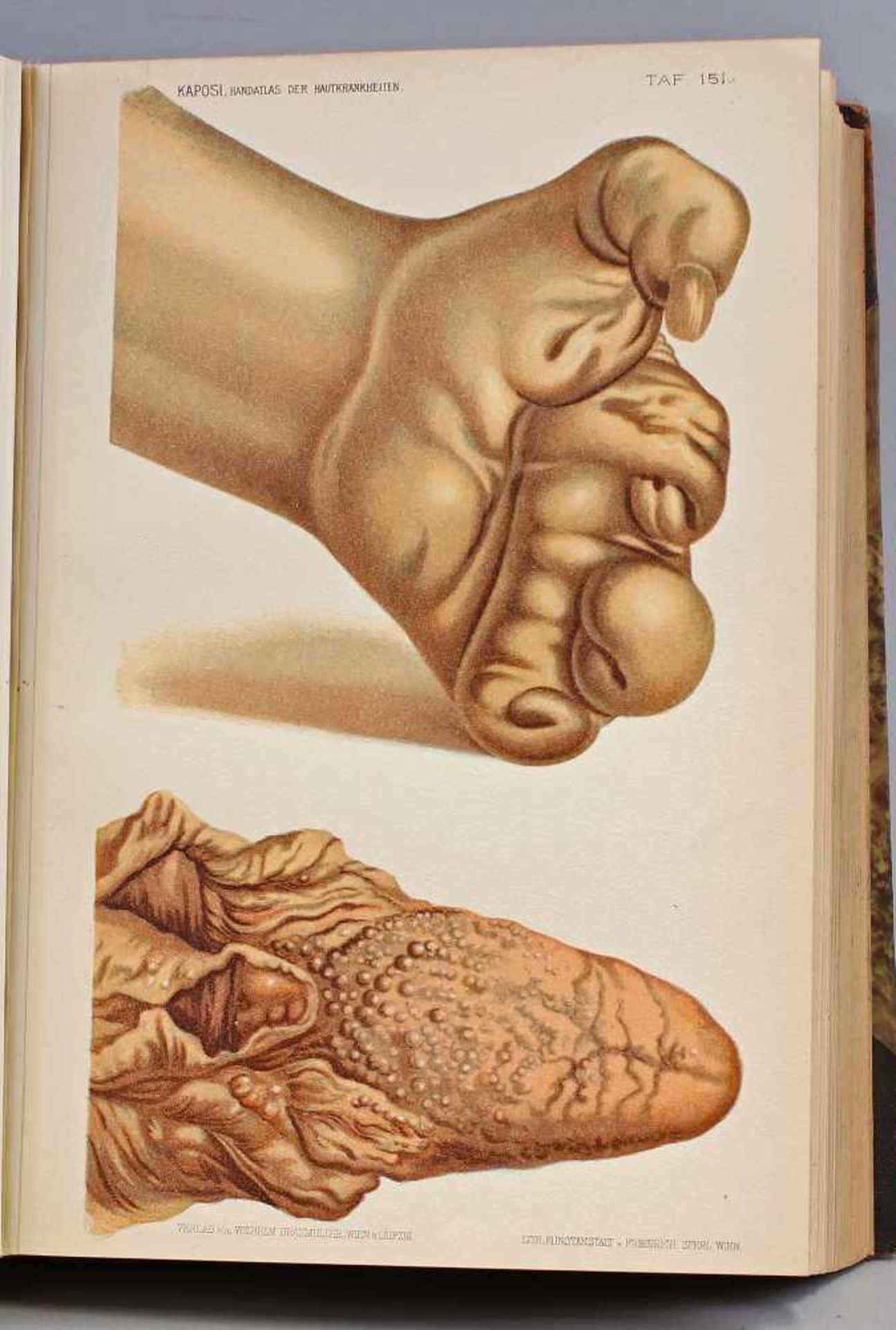2 Bde. Kaposi, Handatlas der Hautkrankheiten v. 1899Handatlas der Hautkrankheiten für Studirende und - Bild 3 aus 4