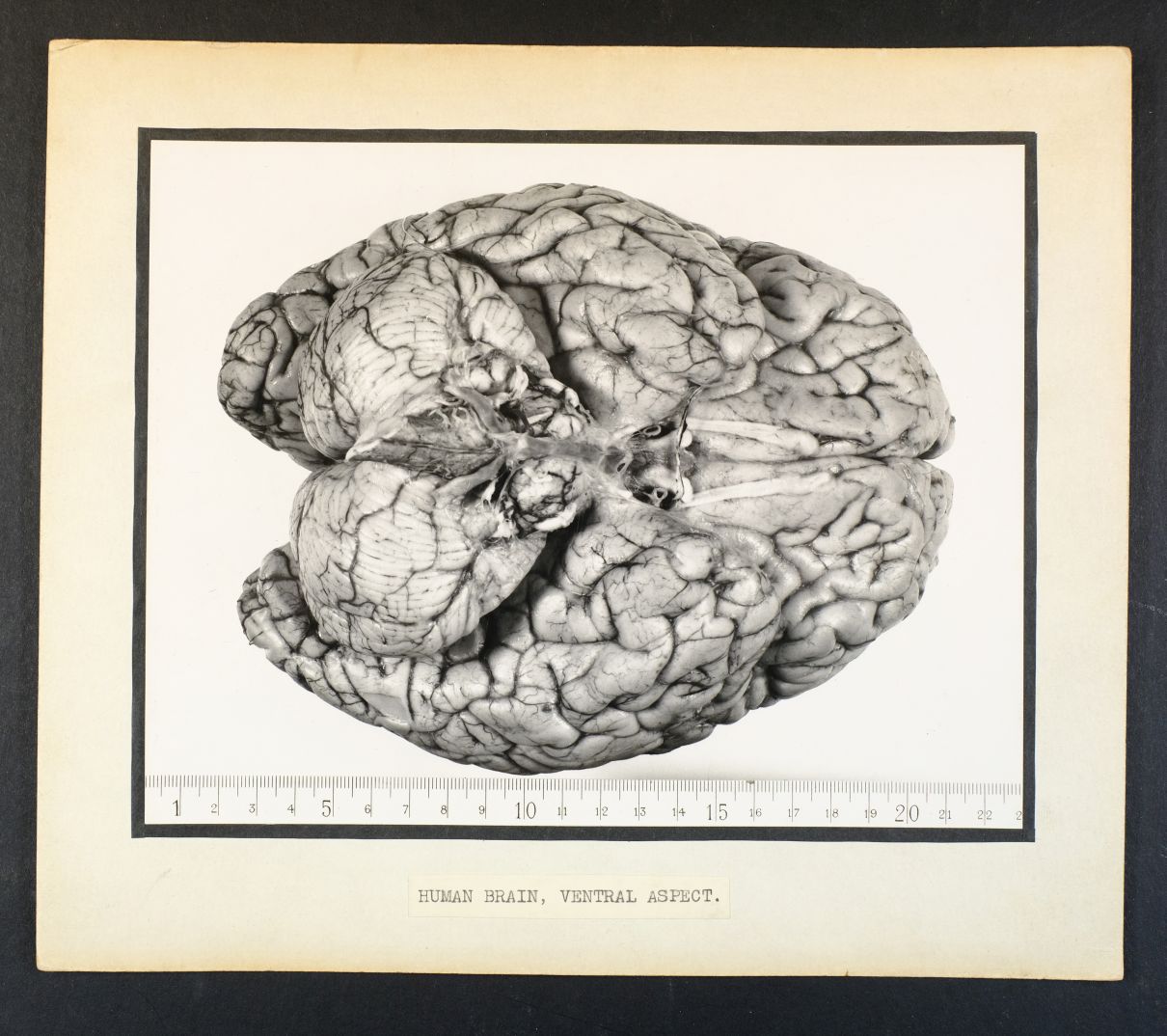 *Army Medical Museum, USA. A surgical photograph of a bullet hole through a human spine, Fort - Image 5 of 6