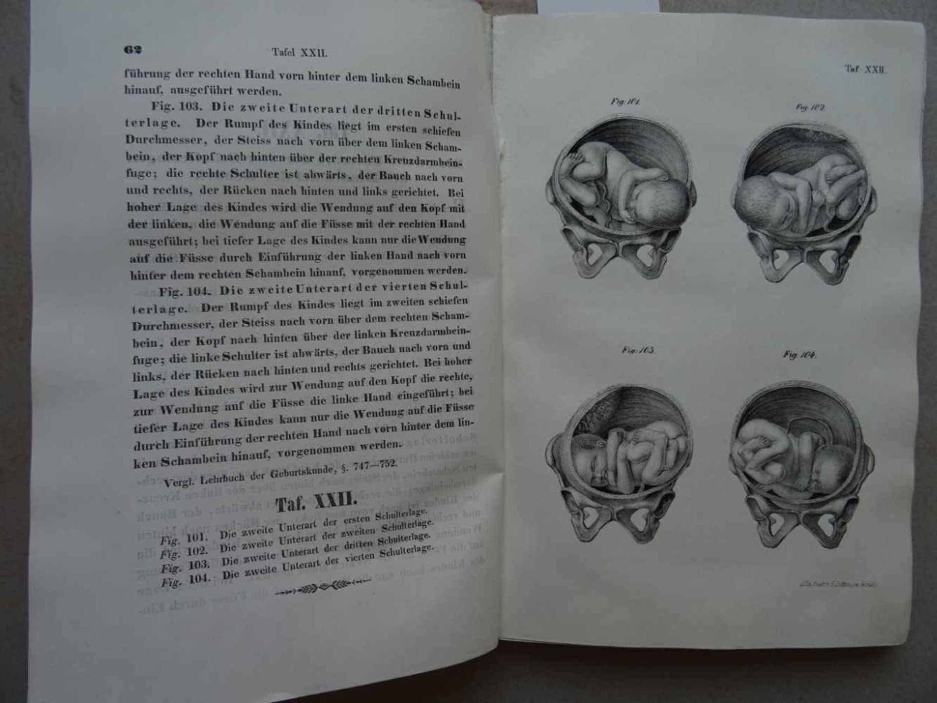 Medizin.- Busch, D.W.H.(Hrsg.). Atlas geburtshülflicher Abbildungen, mit Bezugnahme auf das Lehrbuch - Bild 2 aus 2