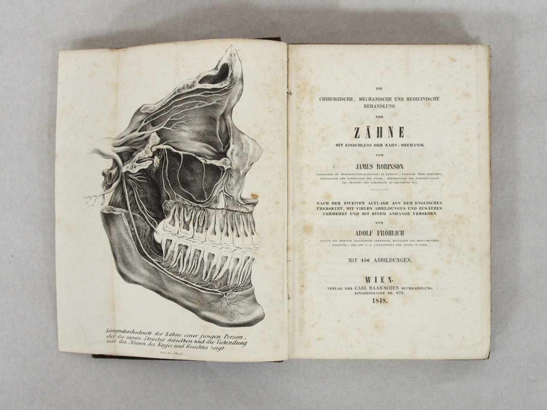 FRÖHLICH, AdolfDie chirugische....Behandlung der Zähne..Wien 1848 (Originaleinband)- - -25.00 %