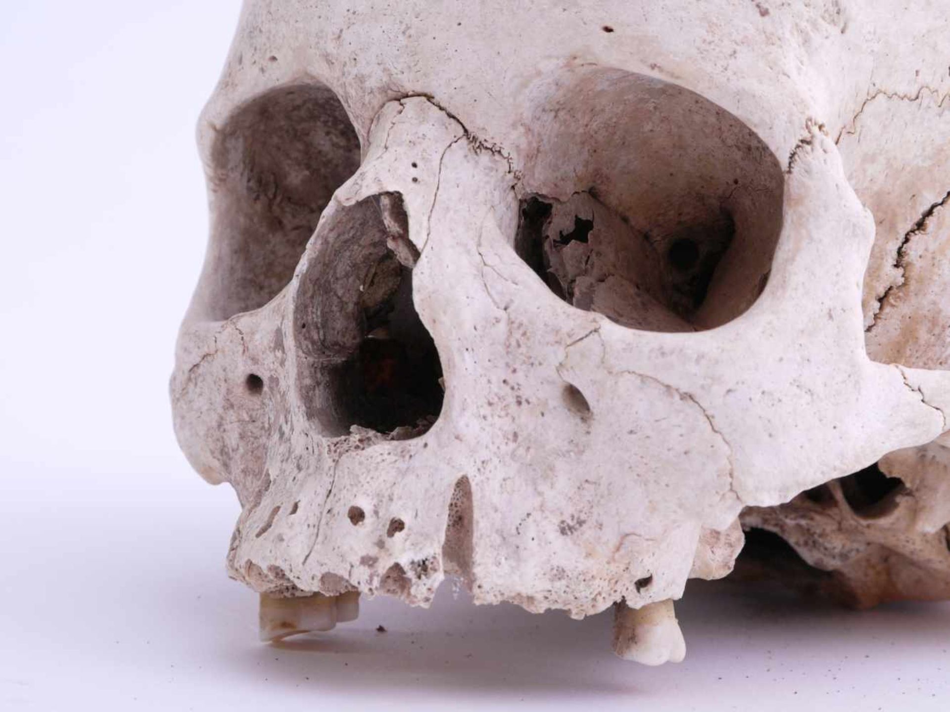 Totenschädel Alter unbestimmtKlar sichtbare Schädelnähte, Unterkiefer fehlend. Drei der hinteren - Bild 2 aus 5