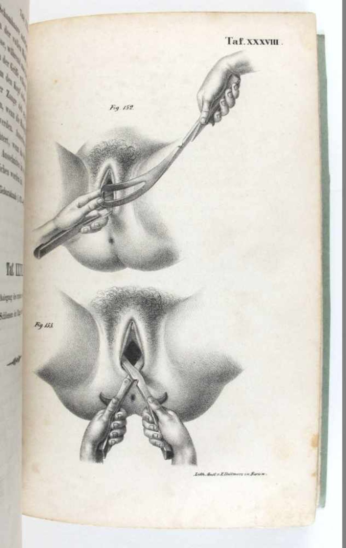 Medizin/Geburtshilfe: Busch, Dr. Dietr(ich) Wilh(elm) Heinr(ich). Atlas geburtshülflicher - Bild 3 aus 3
