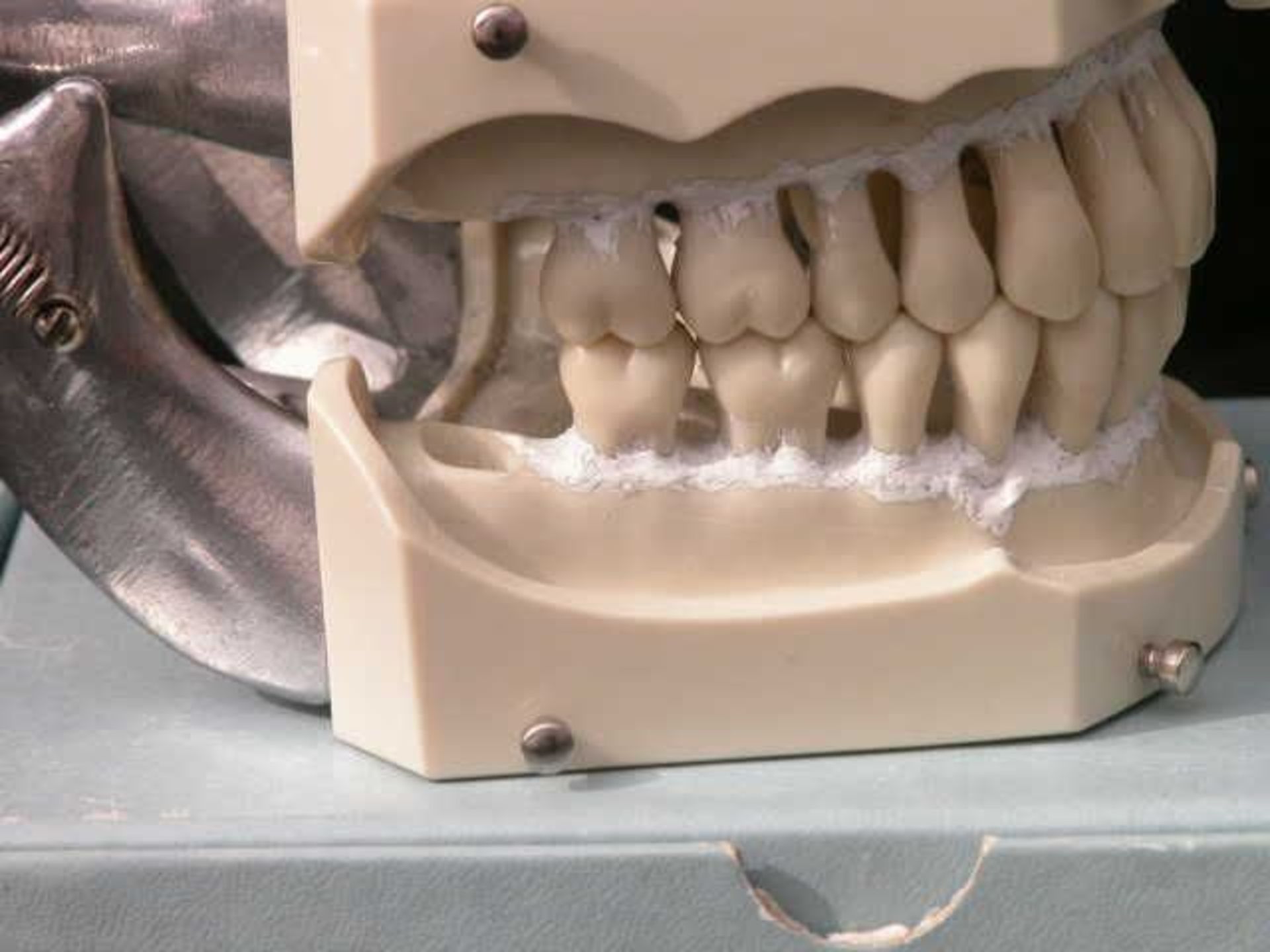 Columbia Dentiform Articulating Dental Model Removeable Teeth #2 4 Molars Gone, Qty 4, 330772226991 - Image 4 of 4