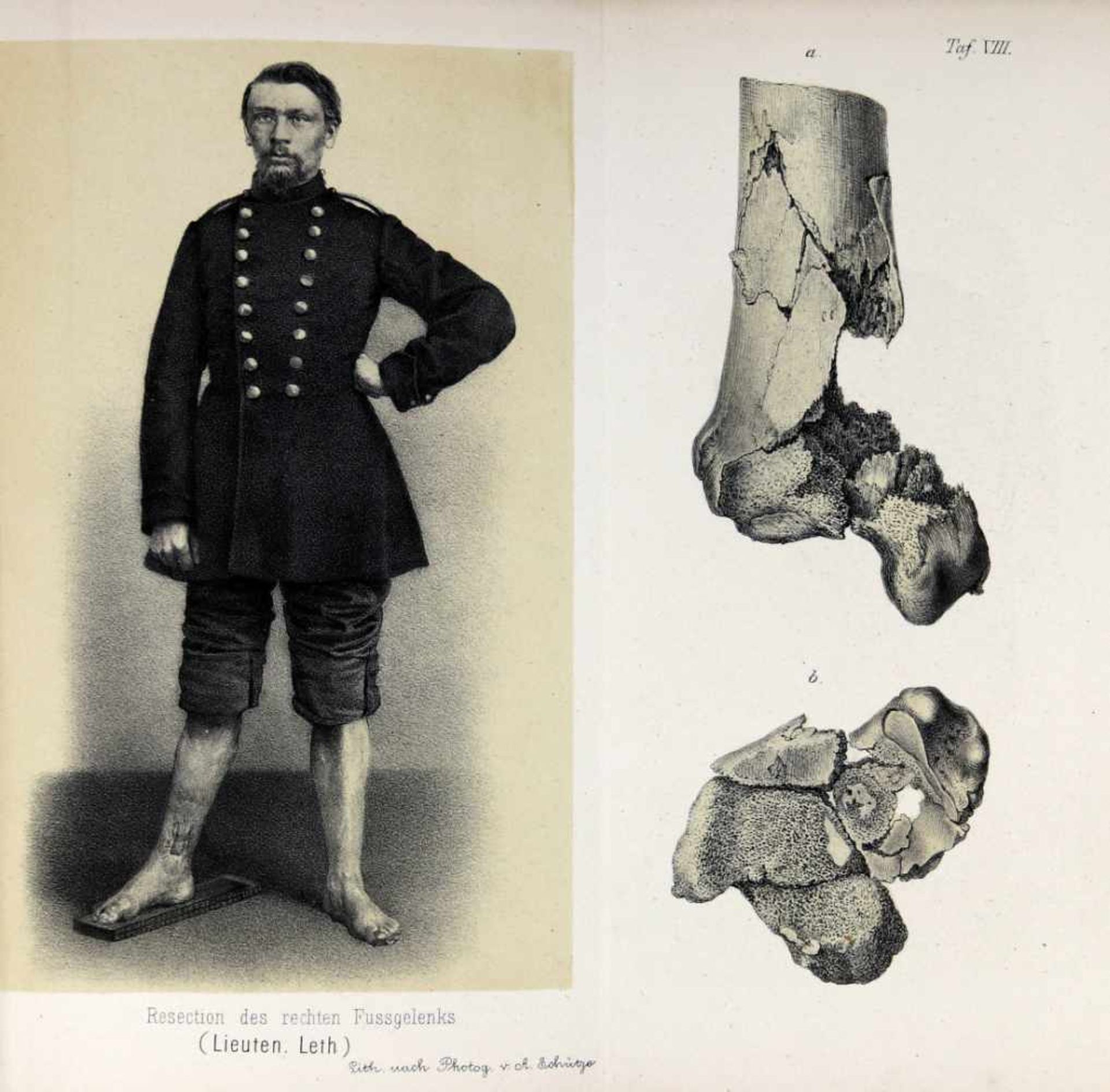 Feldchirurgie. -Langenbeck, Bernhard von:Chirurgische Beobachtungen aus dem Kriege. Berlin, August - Bild 3 aus 3