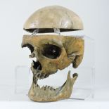 A medical partial human skull, with cut cranium, associated top and jaw and teeth removed.