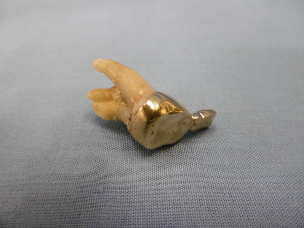 A gold mounted tooth