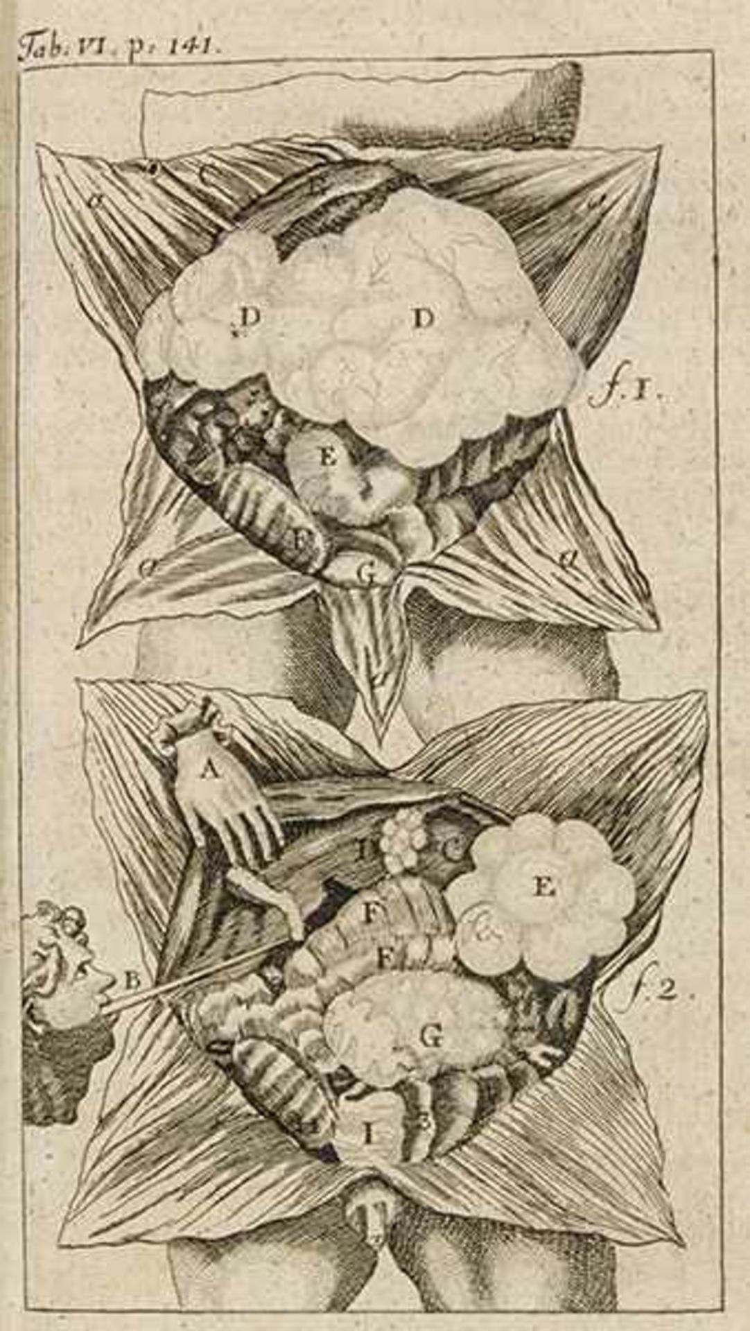 Medizin - Chirurgie - - Garengeot, Rene Jacques Croissant de. Splanchnologia sive anatomia viscerum. - Bild 3 aus 3