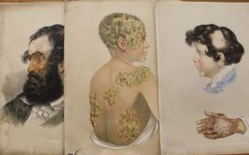 Six 19th century medical skin conditions chromolithographs printed by W West of Hatton Garden,