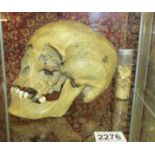 A 19th century or earlier human dentistry scull with container of teeth.