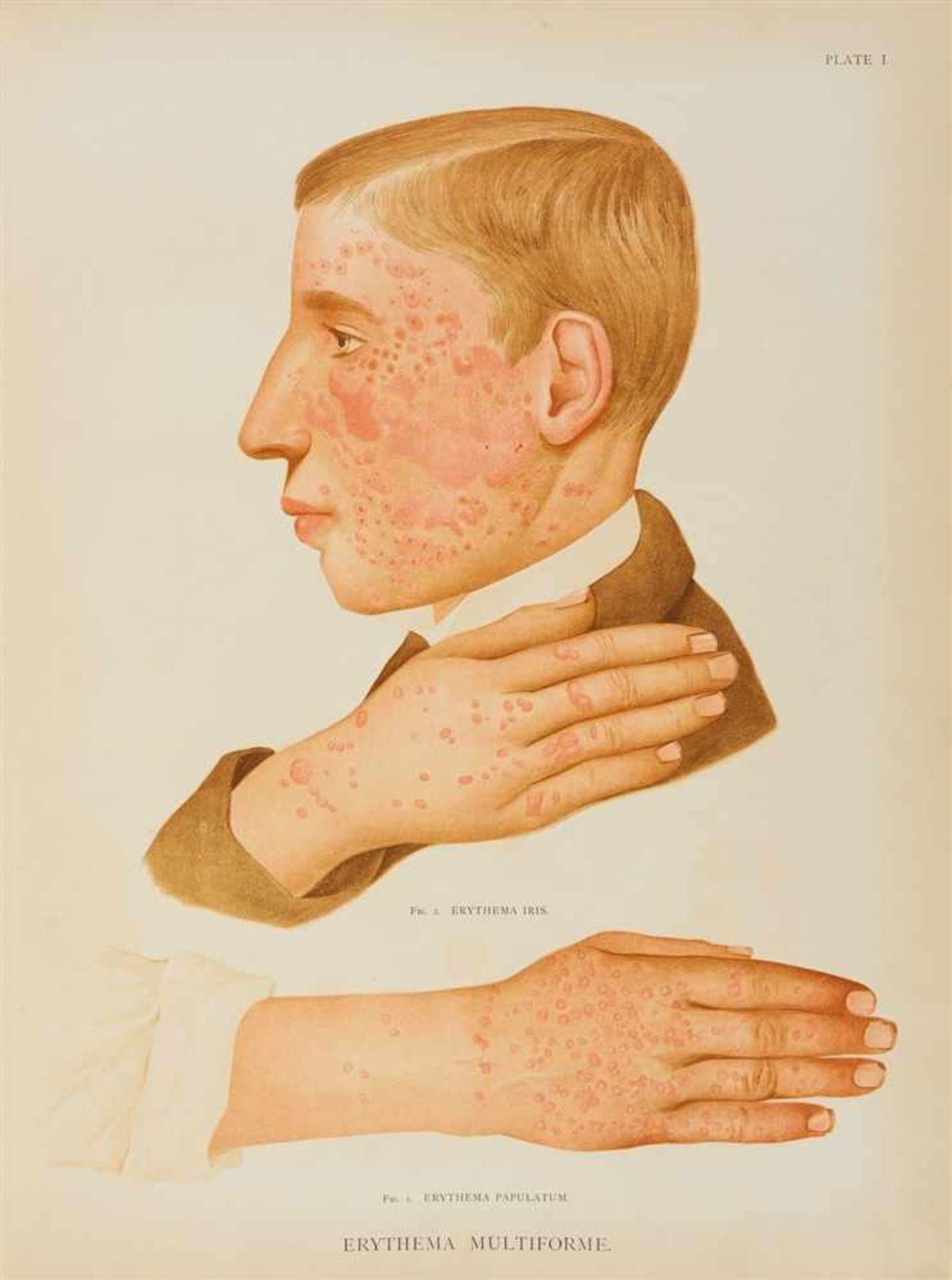 Crocker, Henry Radcliffe: Atlas of the diseases of the skin. In a series of illustrations from