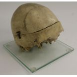 Medical Interest - Anatomy - a human skull, dissected to show cranial fossae,