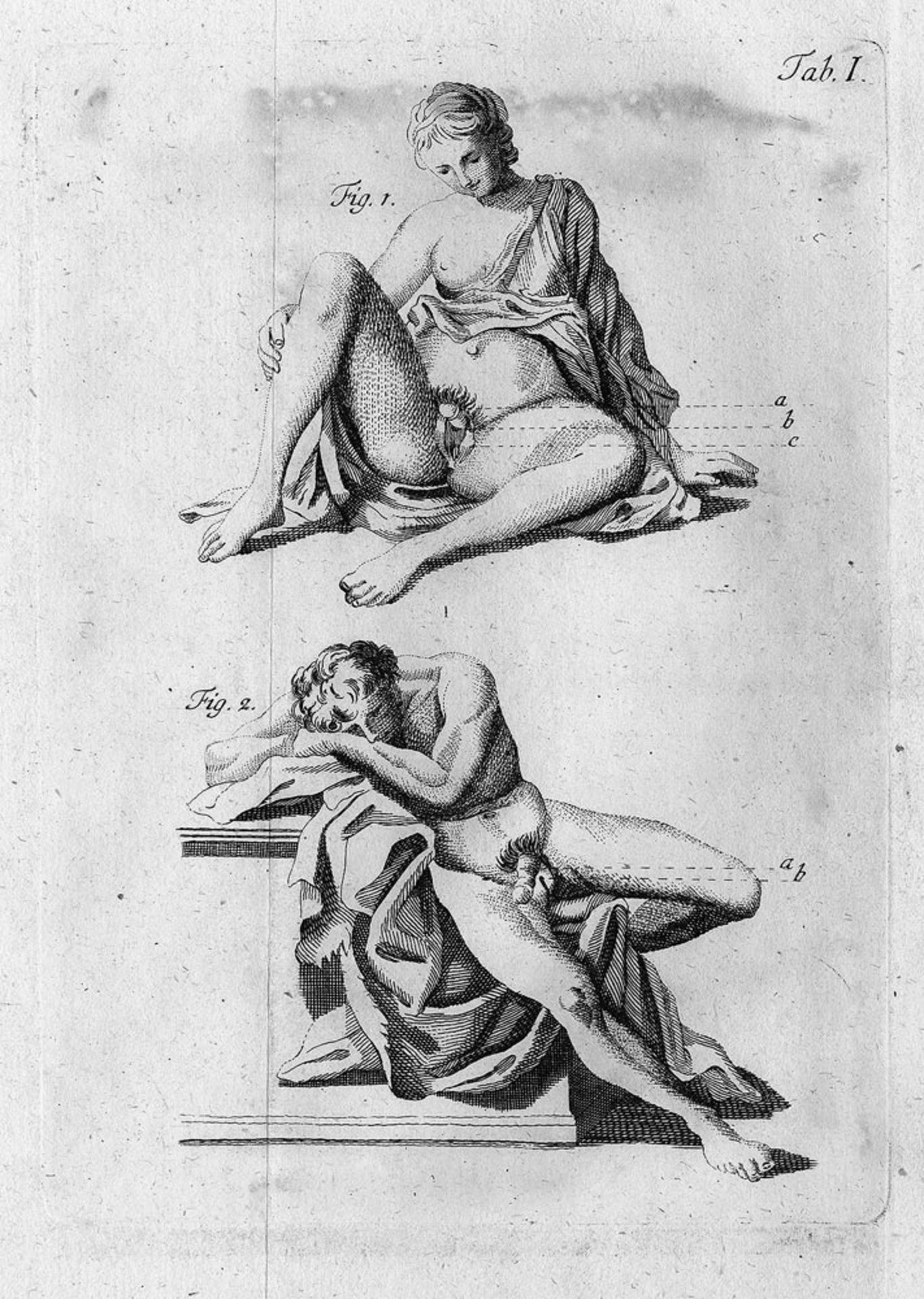 Arnaud de Ronsil, Georg: Anatomisch-Chirurgische Abhandlung über die Hermaphroditen