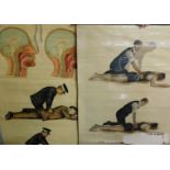 Two Ruddiman Johnstone & Company anatomical posters, illustrating leg breaks and fractures, 46cm