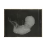 A Half Plate X-Ray of a Human Foetus
