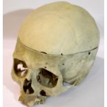 Medical/Dental Interest - Human skull, having removable upper section, lacking lower jaw. P&P