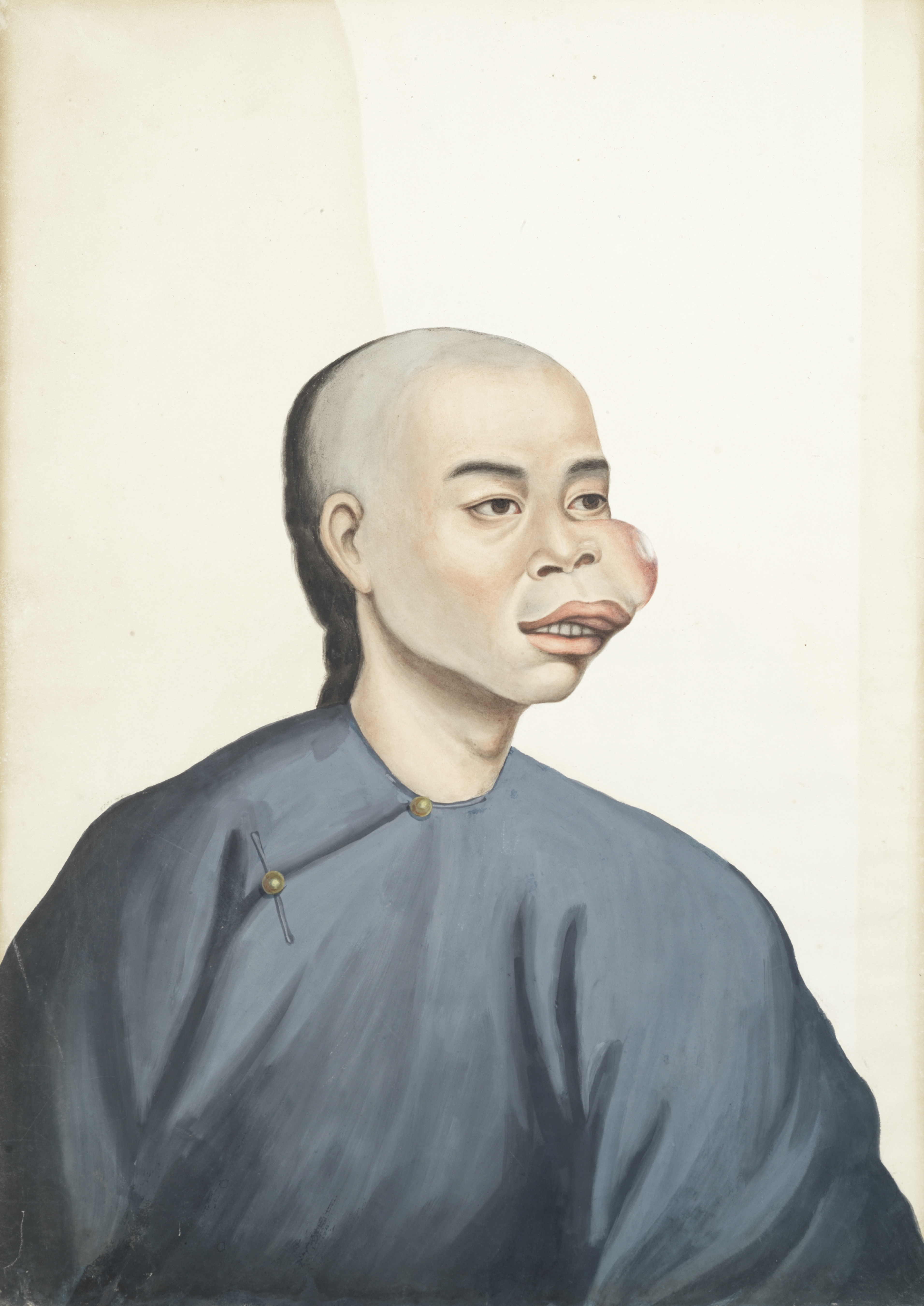 After Lamqua, 19th Century A group of five medical portraits depicting Chinese people with large...