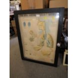 A DISPLAY CASE OF A TRINITY 3D DIAGRAM OF THE RESPIRATORY SYSTEM AND ASTHMA - H 76 CM BY W 58 CM