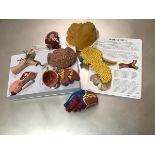 An anatomical model highlighting Diabetes type 2 complications, complete with information leaflet