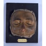 AN UNUSUAL FRENCH ANATOMICAL WAX STUDY OF A DISEASED FACE Granulosis Nasi. 22 cm x 16 cm.