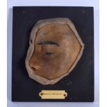 AN UNUSUAL FRENCH ANATOMICAL WAX STUDY OF A DISEASED FACE Adenoma Sebaceum. 18 cm x 15 cm.