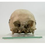 Human Anatomy Skull: displayed in two sections to show inner & outer cranial bones & eye sockets,