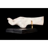 A PLASTER CAST OF A DEFORMED FOOT