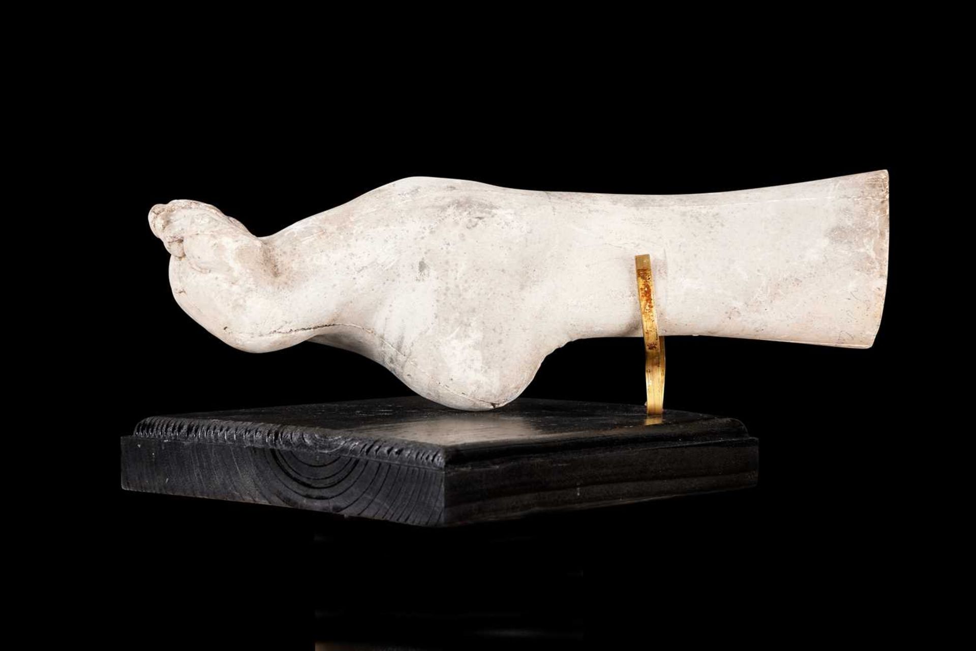 A PLASTER CAST OF A DEFORMED FOOT