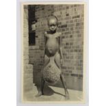Medical. Elephantiasis - nude native child with swollen testicles, real photo postcard published