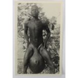 Medical. Elephantiasis - nude native man with swollen testicles, real photo postcard published by