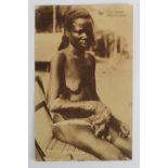 Medical. Elephantiasis - nude native woman with swollen hand and arm, Belgian Congo postcard c1908.