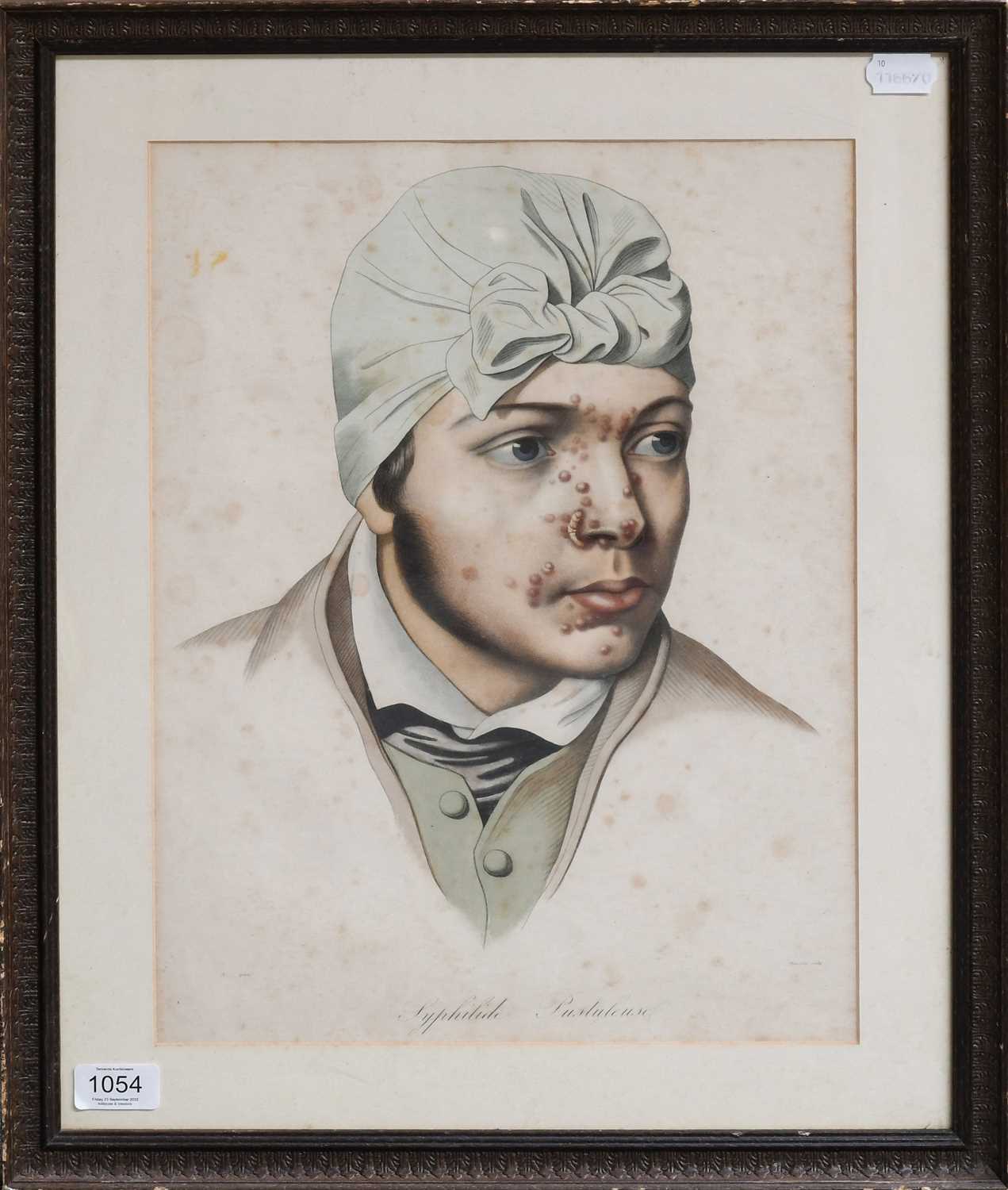 Syphilide PustuleusePortrait of a man with pustular syphilis, coloured print, engraved by Manceau, - Image 2 of 2