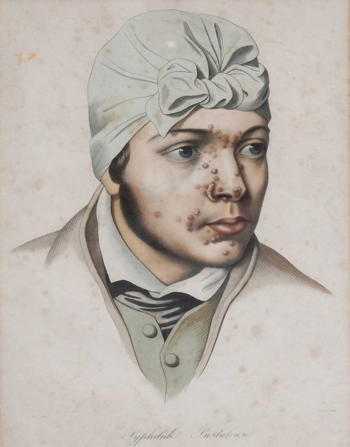 Syphilide PustuleusePortrait of a man with pustular syphilis, coloured print, engraved by Manceau,