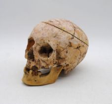 A human skull, with some replacement resin parts and blunt force trauma suffered to the back- used