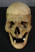 A human skull. Gender and age unknown. Probably used for a medical purpose with the top of the