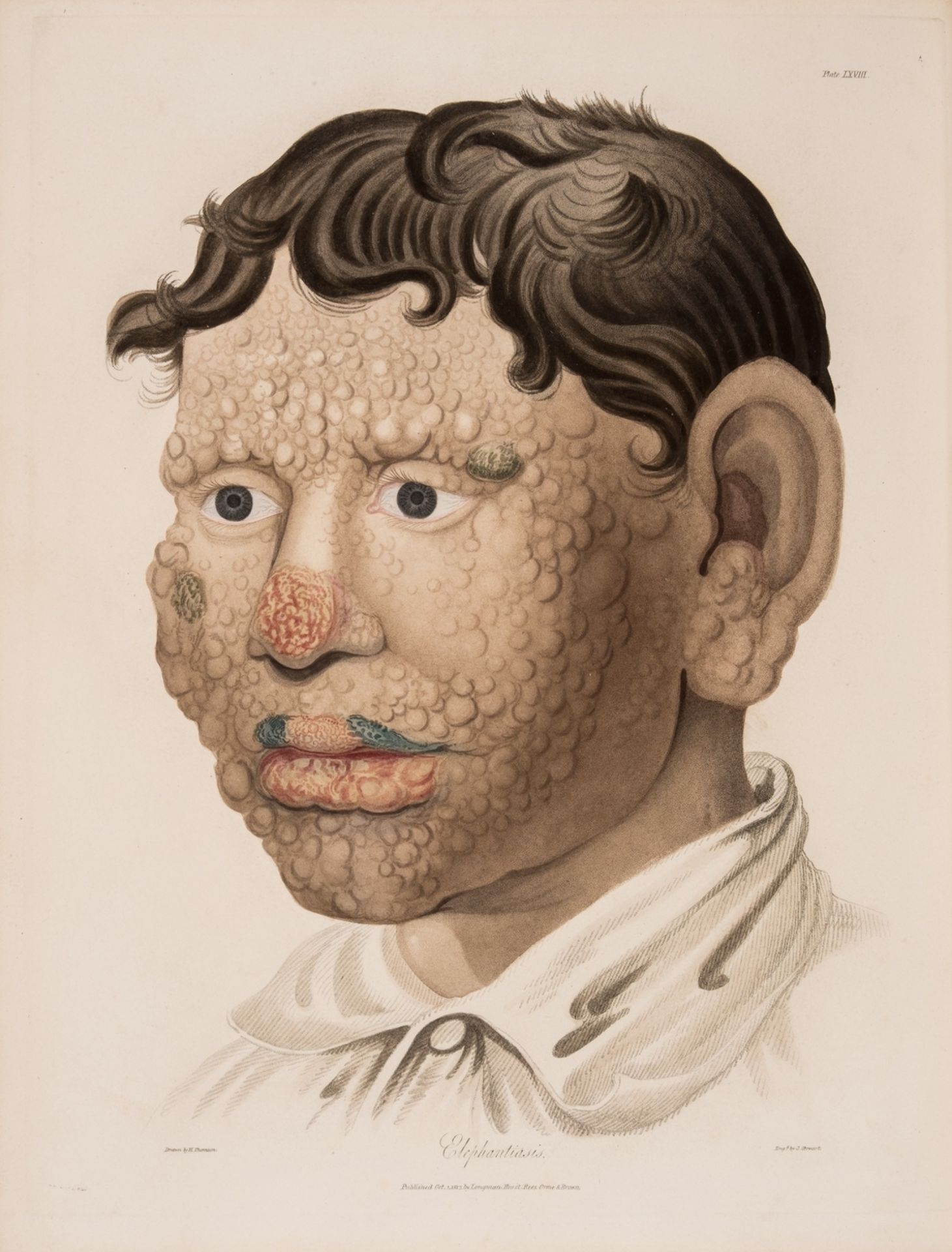 Dermatology.- Baterman (Thomas) Delineations of Cutaneous Diseases, new edition, 1840.