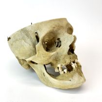 A partial human skull articulated for medical use.