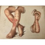 (Medical Interest) Ten Victorian / Edwardian Educational Illustrations of Skin Disease: Selections