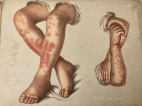 (Medical Interest) Ten Victorian / Edwardian Educational Illustrations of Skin Disease: Selections