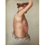 (Medical Interest) Twelve Victorian / Edwardian Educational Illustrations of Skin Disease: