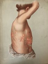 (Medical Interest) Twelve Victorian / Edwardian Educational Illustrations of Skin Disease: