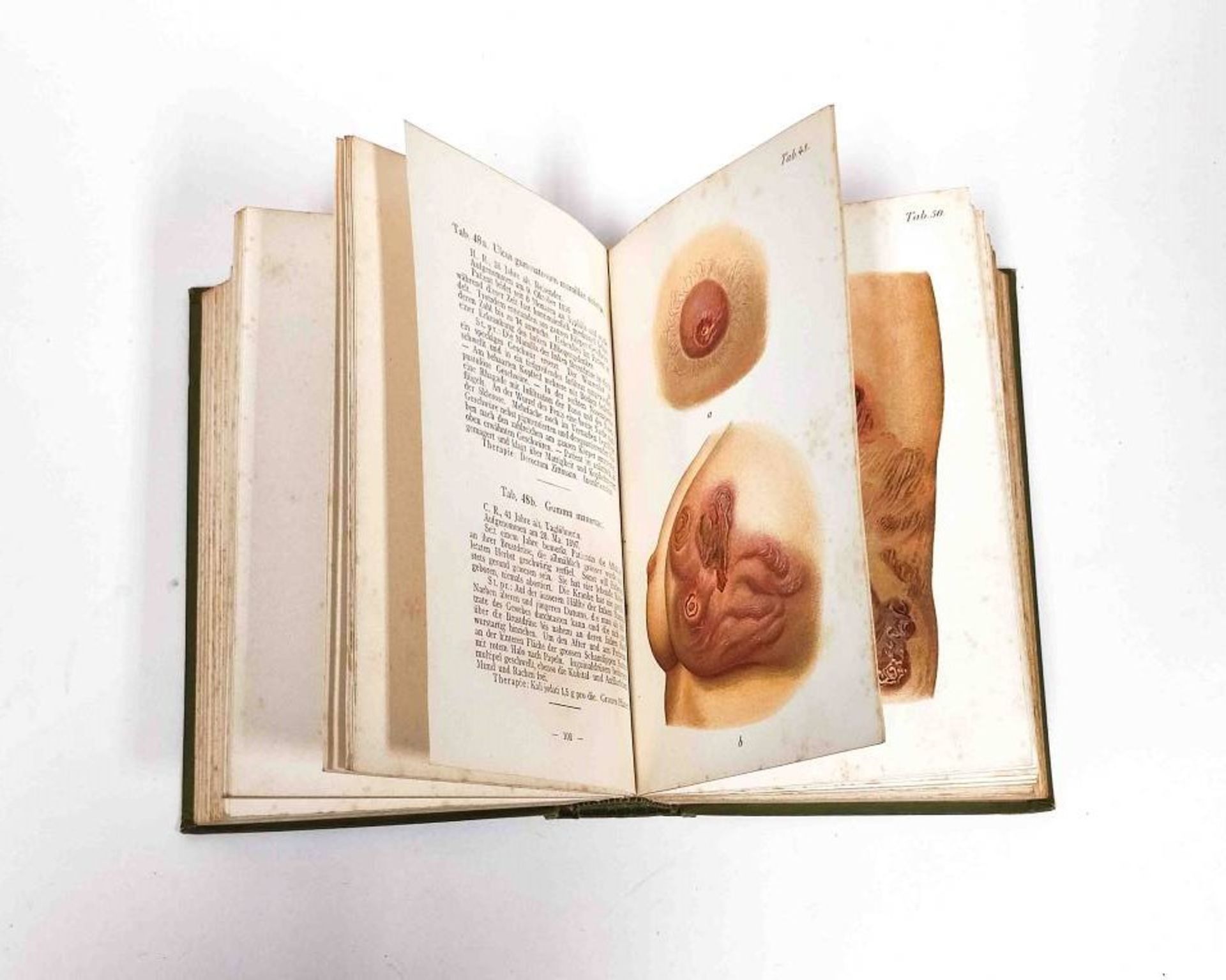 Antikes Medizinbuch Atlas der Syphilis 1898