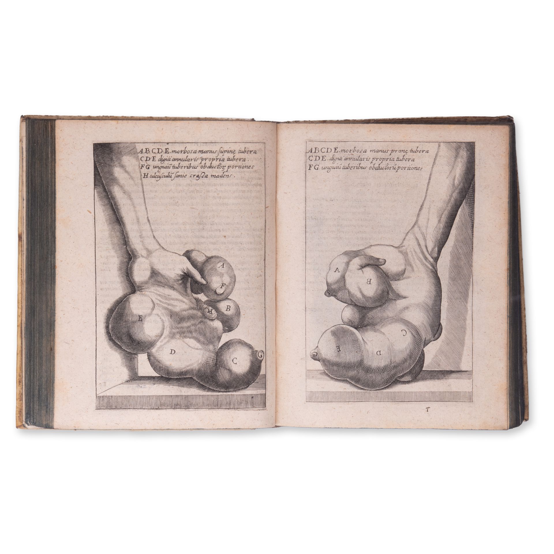 SEVERINO, Marco Aurelio (1580-1656): De Recondita abscessuum natura - Bild 3 aus 4