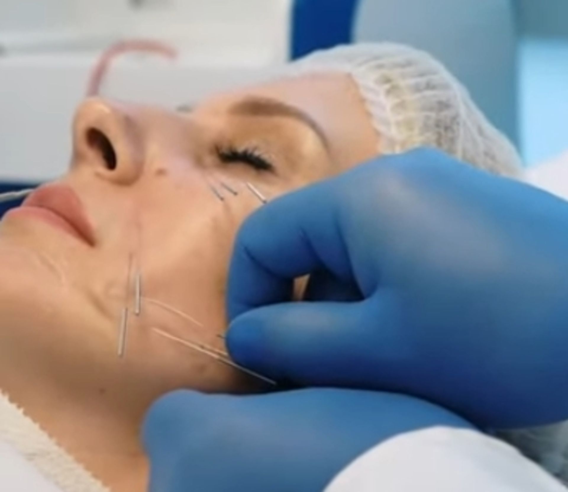 1 x GMV Needle Shaping System For None Surgical Facial and Body Reconstruction - Image 8 of 9