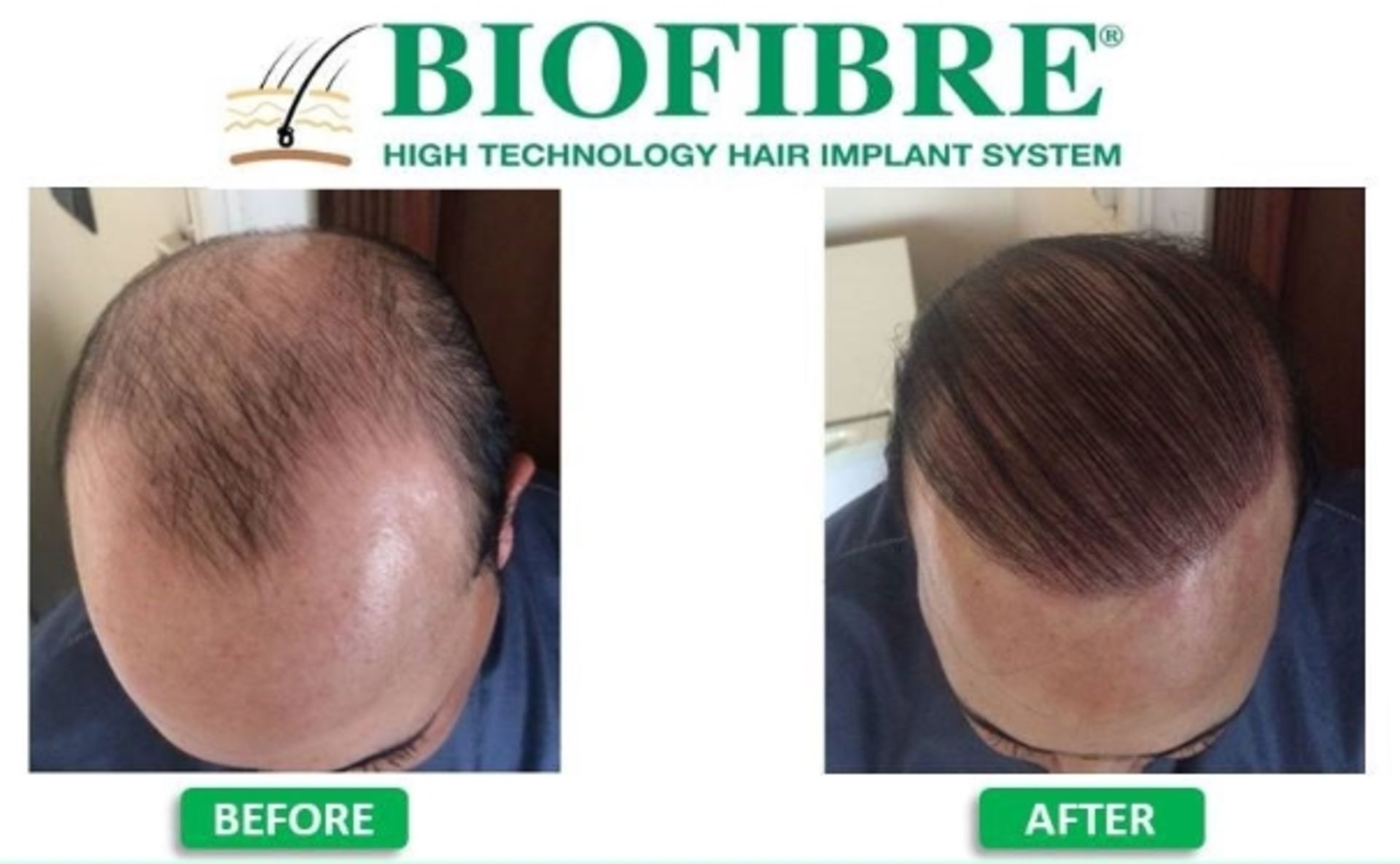 1 x Medicap BioFibre High Technology Hair Transplant System - Image 2 of 7