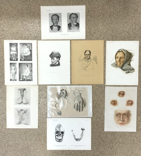 A QUANTITY OF VICTORIAN A3 MEDICAL ILLUSTRATION PLATES FROM ATLAS OF CLINICAL MEDICINE, DR BYROM - Image 2 of 2